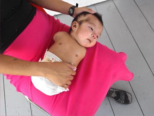 Fødselsskader. er det noe galt med babyen min? Fødselsskader. er det noe galt med babyen min?