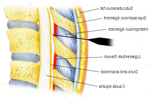 Epidural anestesi. et fall i blodtrykket. Epidural anestesi. et fall i blodtrykket.