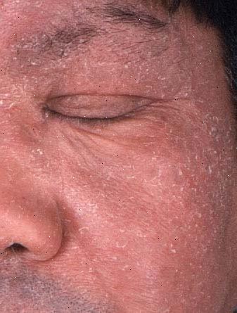 Kronisk aktinisk dermatitt. hva er kronisk aktinisk dermatitt? Kronisk aktinisk dermatitt. hva er kronisk aktinisk dermatitt?