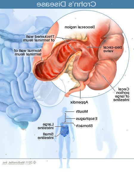 Crohns sykdom. hva er Crohns sykdom? Crohns sykdom. hva er Crohns sykdom?