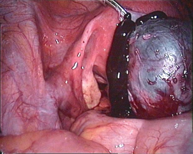 Endometriose. hva er endometriose? Endometriose. hva er endometriose?