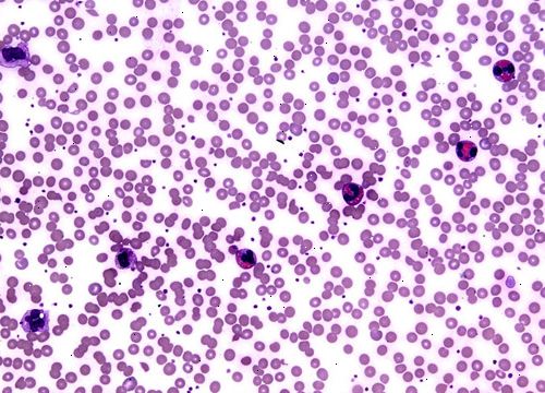Eosinofili. hva er eosinofile? Eosinofili. hva er eosinofile?