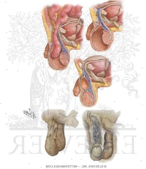 Hydrocele og varicocele. hvordan utvikler en hydrocele? Hydrocele og varicocele. hvordan utvikler en hydrocele?