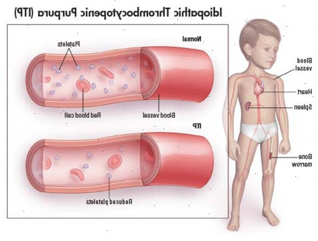 Idiopatisk trombocytopenisk purpura (ITP). alternative behandlinger for ITP. Idiopatisk trombocytopenisk purpura (ITP). alternative behandlinger for ITP.