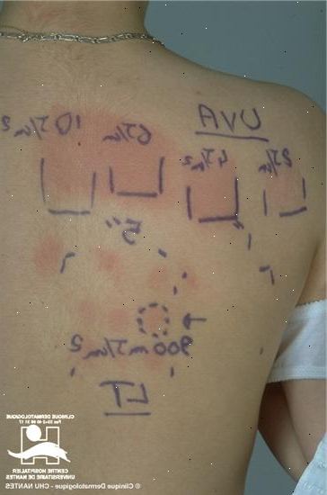 Solar urticaria. legemidler som demper immunforsvaret. Solar urticaria. legemidler som demper immunforsvaret.