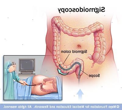 Sigmoidoskopi - undersøke endetarmen. hva er sigmoidoscopy? Sigmoidoskopi - undersøke endetarmen. hva er sigmoidoscopy?