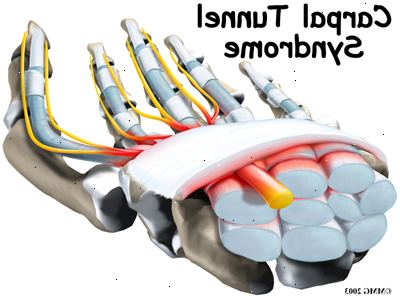 Carpal tunnel syndrom. hva er symptomene på carpal tunnel syndrom? Carpal tunnel syndrom. hva er symptomene på carpal tunnel syndrom?