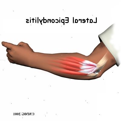 Tennisalbue (lateral epikondylitt). hva er tennisalbue? Tennisalbue (lateral epikondylitt). hva er tennisalbue?