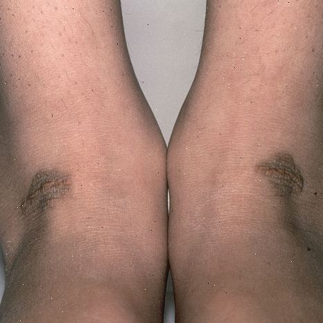 Familiær hyperkolesterolemi (FH). high-density lipoproteiner. Familiær hyperkolesterolemi (FH). high-density lipoproteiner.