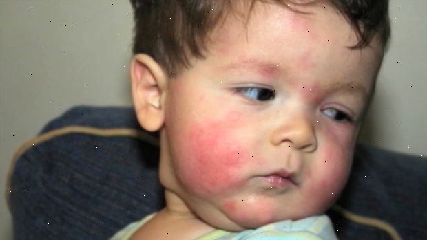 Matallergier hos barn. hva er matvareallergi? Matallergier hos barn. hva er matvareallergi?