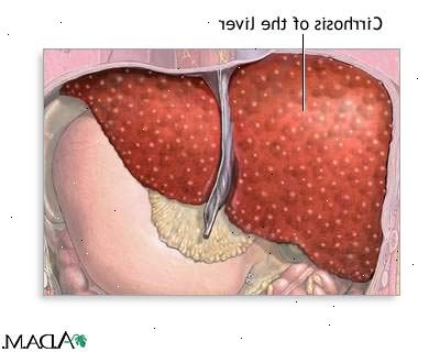 Skrumplever. alkoholfrie steato-hepatitt (NASH). Skrumplever. alkoholfrie steato-hepatitt (NASH).