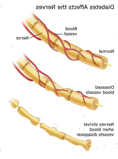 Diabetisk nevropati (nervesykdom). hvordan påvirker det nervesystemet? Diabetisk nevropati (nervesykdom). hvordan påvirker det nervesystemet?