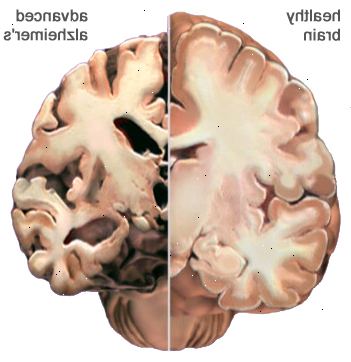 Alzheimers sykdom. det som er Alzheimers sykdom? Alzheimers sykdom. det som er Alzheimers sykdom?