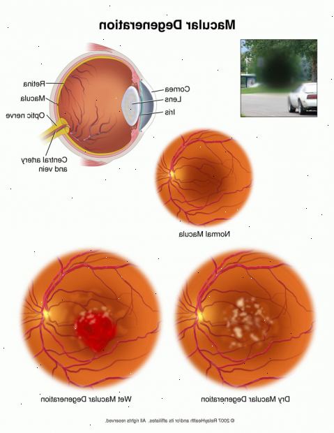 Aldersrelatert macula degenerasjon. hva er aldersrelatert makuladegenerasjon? Aldersrelatert macula degenerasjon. hva er aldersrelatert makuladegenerasjon?