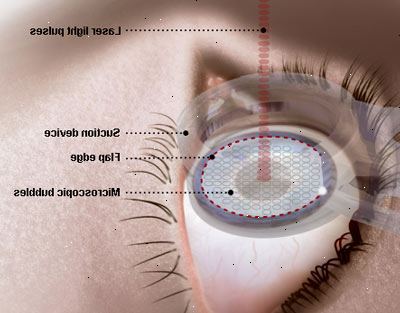 Laser øye kirurgi. hva er laser øye kirurgi? Laser øye kirurgi. hva er laser øye kirurgi?