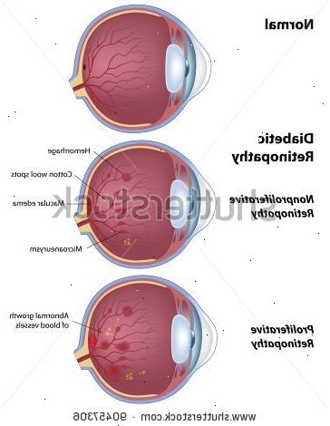 Diabetisk retinopati (øyesykdom). hva som forårsaker diabetisk retinopati? Diabetisk retinopati (øyesykdom). hva som forårsaker diabetisk retinopati?