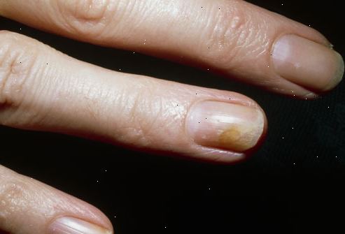 Fungal spiker infeksjon (ringworm av negler). hva er ringworm av negler? Fungal spiker infeksjon (ringworm av negler). hva er ringworm av negler?
