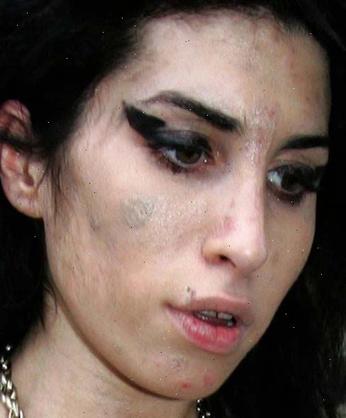 Impetigo. er impetigo farlig? Impetigo. er impetigo farlig?