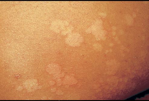 Pityriasis versicolor. hva er pityriasis versicolor? Pityriasis versicolor. hva er pityriasis versicolor?