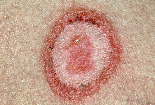 Ringorm (tinea corporis). hva som forårsaker ringorm? Ringorm (tinea corporis). hva som forårsaker ringorm?