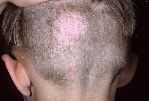 Ringorm i hodebunnen (tinea capitis). det som er ringorm i hodebunnen? Ringorm i hodebunnen (tinea capitis). det som er ringorm i hodebunnen?
