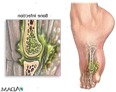 Osteomyelitt. hva er osteomyelitt? Osteomyelitt. hva er osteomyelitt?