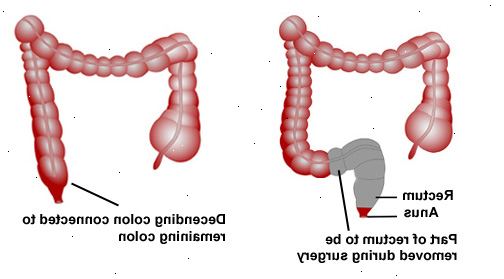 Abdomino-perineal reseksjon av rektum. etter andndash; på sykehus. Abdomino-perineal reseksjon av rektum. etter andndash; på sykehus.