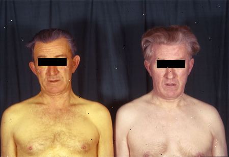 Gilberts syndrom. andre årsaker til gulsott. Gilberts syndrom. andre årsaker til gulsott.