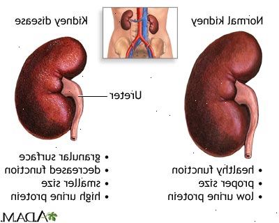 Diabetisk nyresykdom. kontinuerlig ambulatorisk peritonealdialyse. Diabetisk nyresykdom. kontinuerlig ambulatorisk peritonealdialyse.