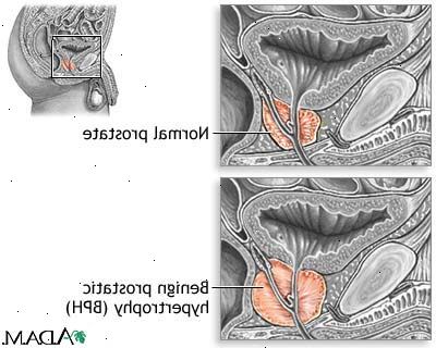 Benign prostatahyperplasi (BPH). hva er benign prostatahyperplasi? (BPH). Benign prostatahyperplasi (BPH). hva er benign prostatahyperplasi? (BPH).