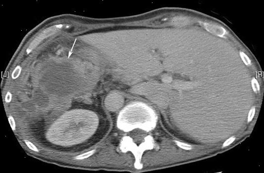 Abscess intra-abdominal. etter andndash; på sykehus. Abscess intra-abdominal. etter andndash; på sykehus.