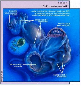 Abscess - bekken. etter andndash; på sykehus. Abscess - bekken. etter andndash; på sykehus.