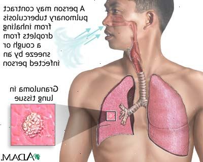 Tuberkulose. hva er tuberkulose? Tuberkulose. hva er tuberkulose?
