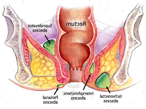 Abscess - perianalt. etter andndash; på sykehus. Abscess - perianalt. etter andndash; på sykehus.