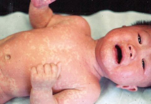Tre-dagers-feber (roseola infantum). hva er tre-dagers-feber? Tre-dagers-feber (roseola infantum). hva er tre-dagers-feber?