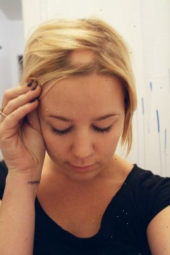 Alopecia. det som er symptomene på alopecia areata? Alopecia. det som er symptomene på alopecia areata?