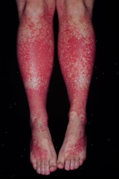 Trombotisk trombocytopenisk purpura (TTP). hva er trombotisk trombocytopenisk purpura? Trombotisk trombocytopenisk purpura (TTP). hva er trombotisk trombocytopenisk purpura?