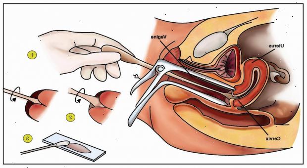 Pap (cervical) celleprøver. hvorfor har en celleprøver? Pap (cervical) celleprøver. hvorfor har en celleprøver?