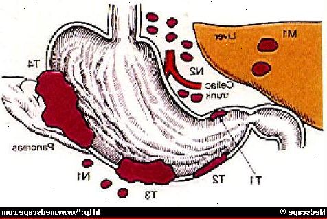 Screening for gastrointestinal kreft. hva er gastrointestinal kreft? Screening for gastrointestinal kreft. hva er gastrointestinal kreft?