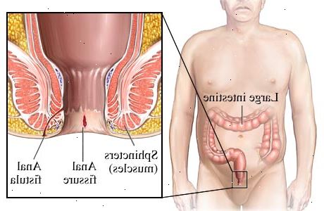 Anal fistel. etter andndash; på sykehus. Anal fistel. etter andndash; på sykehus.