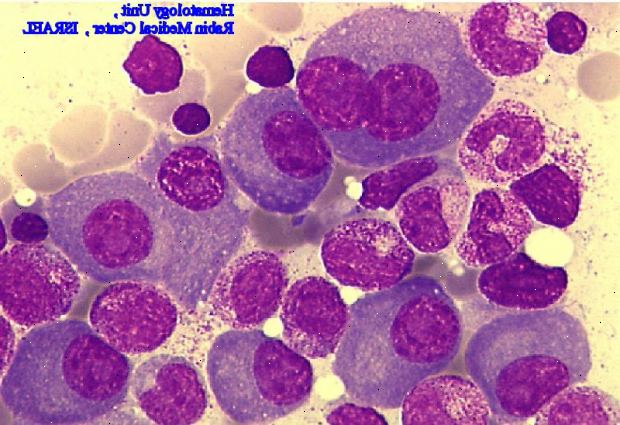 Myelomatose. leukemi forskningsfond. Myelomatose. leukemi forskningsfond.