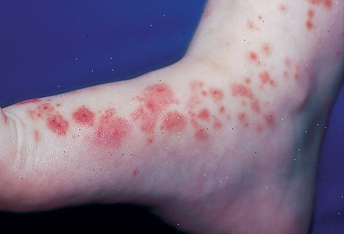 Purpura. hva er årsakene til purpura? Purpura. hva er årsakene til purpura?